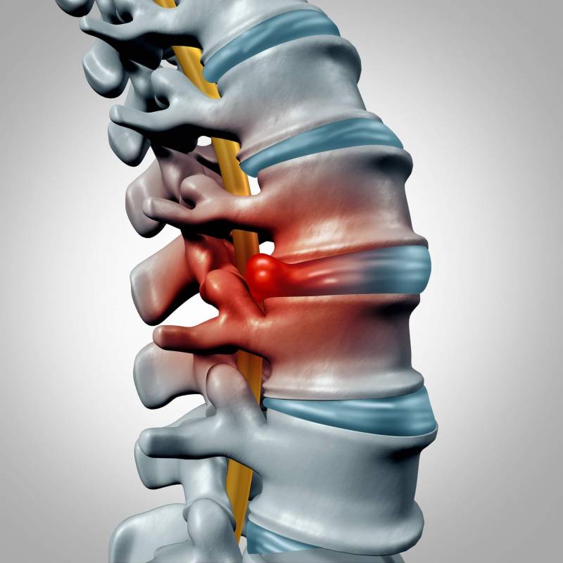 Prolapsed disc